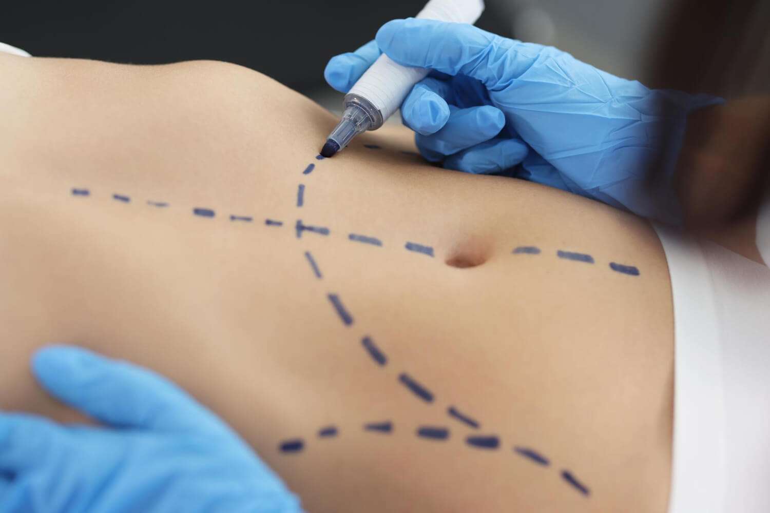 ما هي عملية شفط الدهون؟