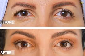 نتائج عملية تجميل الأذن قبل وبعد بالصور