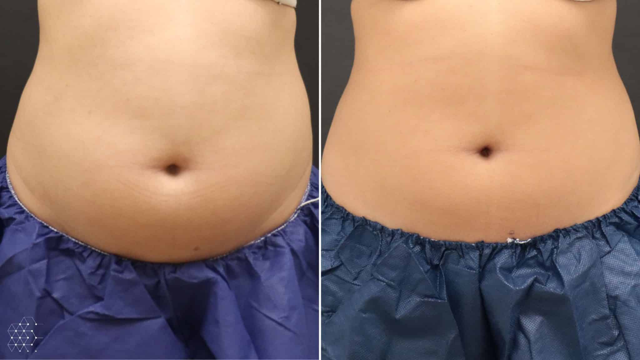 ما هي عملية شد ترهلات البطن السفلية؟