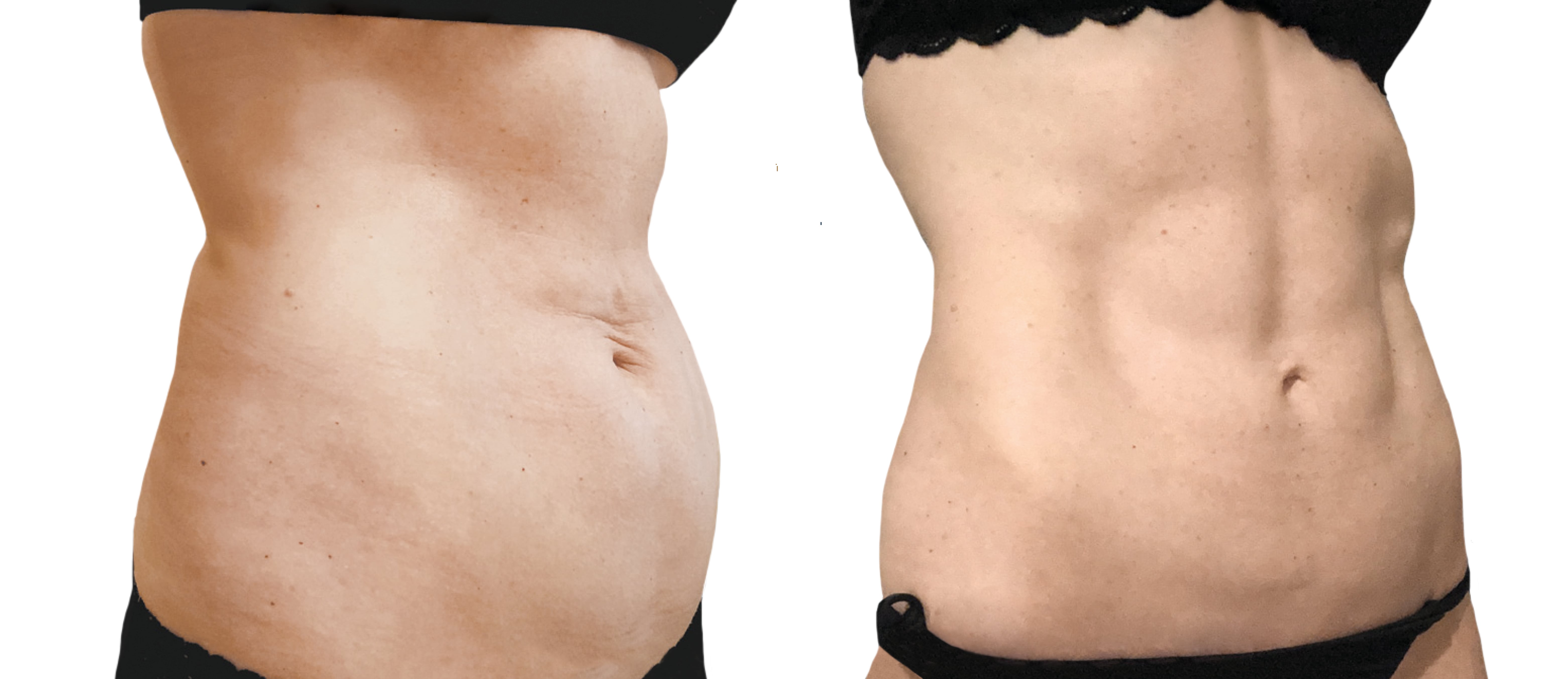 ما بعد عملية شفط الدهون