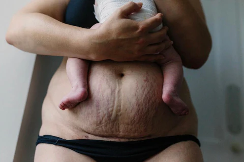 ما هي عملية شد البطن مع الولادة القيصرية؟