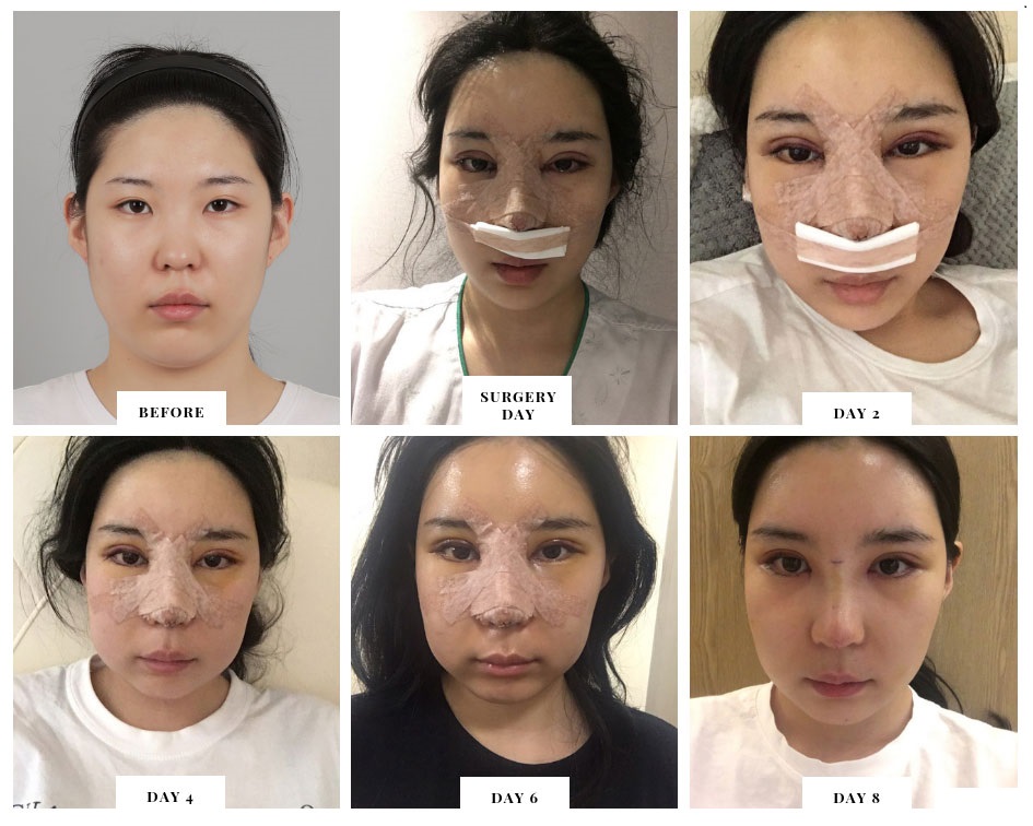 مراحل تغير الأنف بعد عملية التجميل